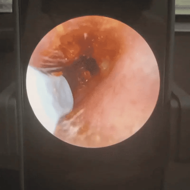 Safe, Gentle, and Clear – Visual Earwax Remover
